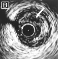 noted on IVUS 14 Reprinted from Yamagishi M