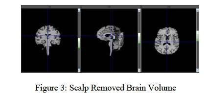 The lower right most panel is devoted for showing volumetric information of brain. 2.1 Loading an Image BrainAssist supports 2D and 3D DICOM files with extension of.dcm.