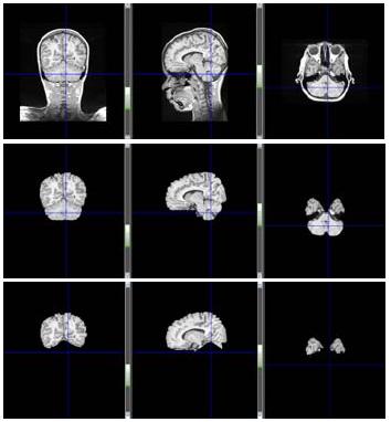 Figure: 4 (a) Original brain volume in different isometric view, (b) Scalp removed, Cerebrum segmented from scalp removed brain volume 3.
