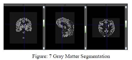 4. Heterotopia Analysis After gray matter segmentation simply click on FCD analysis icon in the Tool bar or Tool menu (Tool -> FCD analysis) we can start the FCD analysis process.