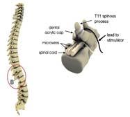 Outline: Intra-Spinal Stimulation 1. Replace: Brain control of 2a.