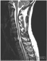 Outline: Intra-Spinal Stimulation 1. Replace: Brain control of 2b.