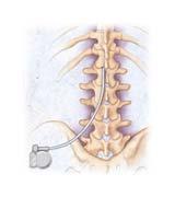Epidural stimulation on cord dorsum activates sensory afferents Intra-spinal stimulation in ventral horn activates spinal motor