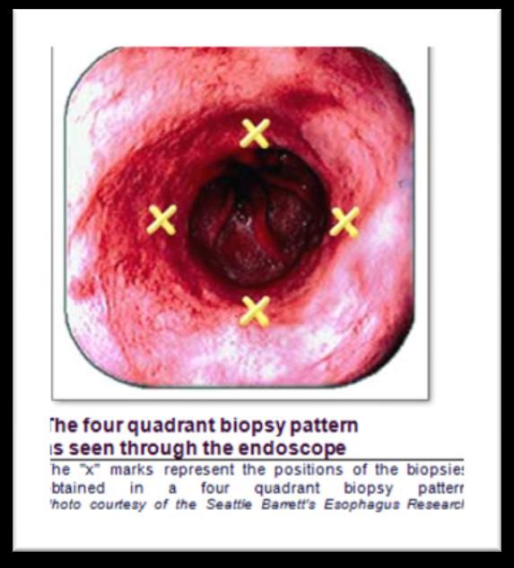 SURVEILLANCE Technique: AGA recommends the Seattle protocol Four quadrants every 1cm-2 cm through the Intestinal Metaplasia visible areas Intervals: Based on