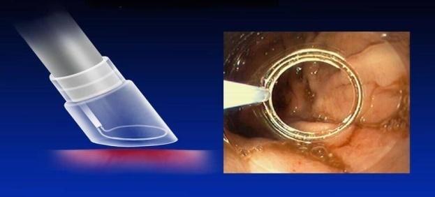Suction and Snare of Lesion Images:http://www.hopkins-gi.