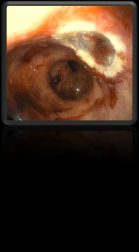 ENDOSCOPIC MUCOSAL RESECTION (EMR) Advantages:I Enables evaluation of changes in diseased tissue Can be used to obtain large biopsies for diagnosis and local tumor staging Frequently reveals more
