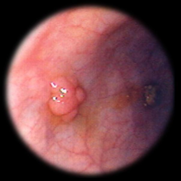 esophagus, just as polypectomy is to the discovery of a colorectal polyp.