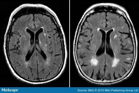 Vaatschade in het brein Vaatschade op MRI Geen