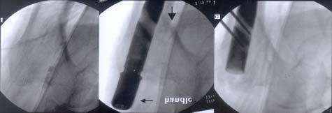 Fig. 2. The fracture fragment displaced as the nail goes insde.