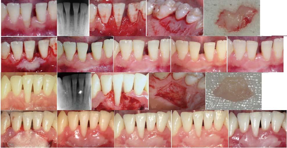 A B C D E F G H I J K L M N O P R S T U Figure 1 Surgical procedures and follow-ups in treatment with gingival unit transfer and free gingival graft.