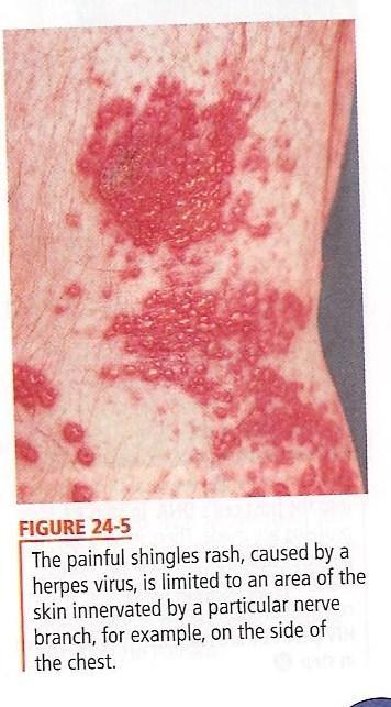 2. Human Viral Disease a. Chickenpox and Shingles 1.