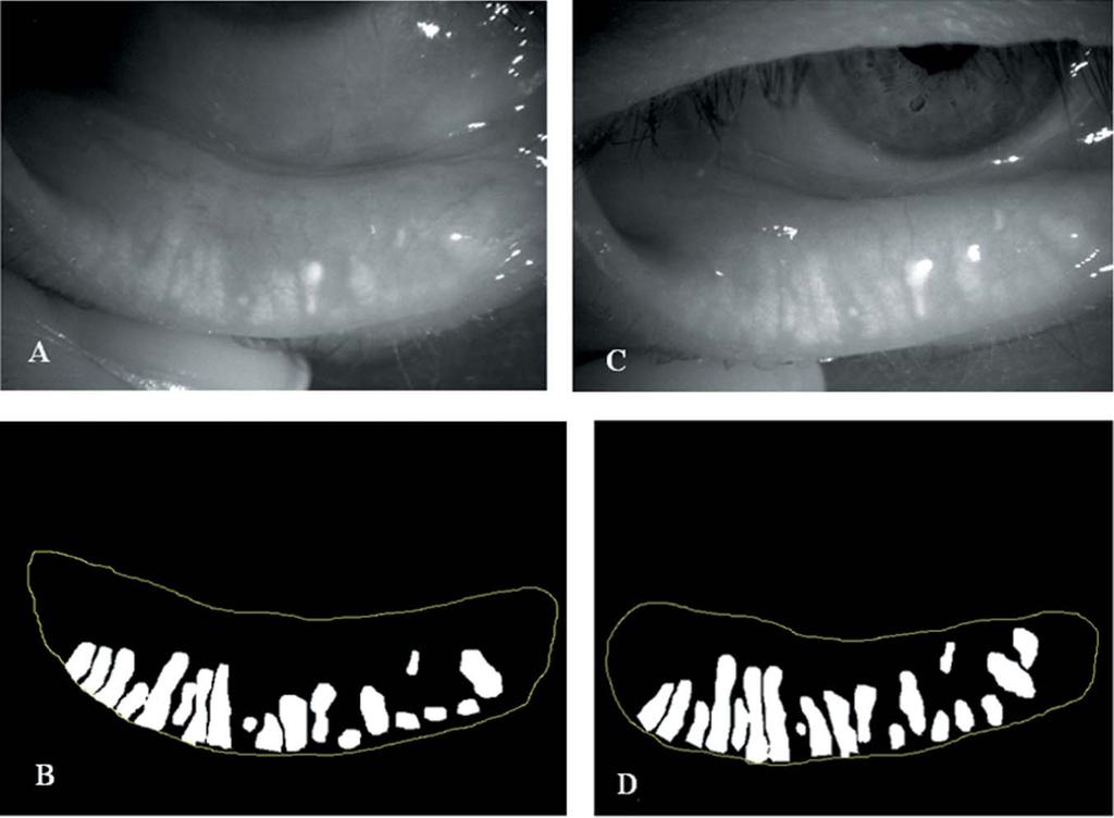 Figure 4 Quantitative image analysis of the meibomian glands before and after therapy with topical diquafosol in case #2. (A and B) Meibomian gland area was 22.0% before therapy.