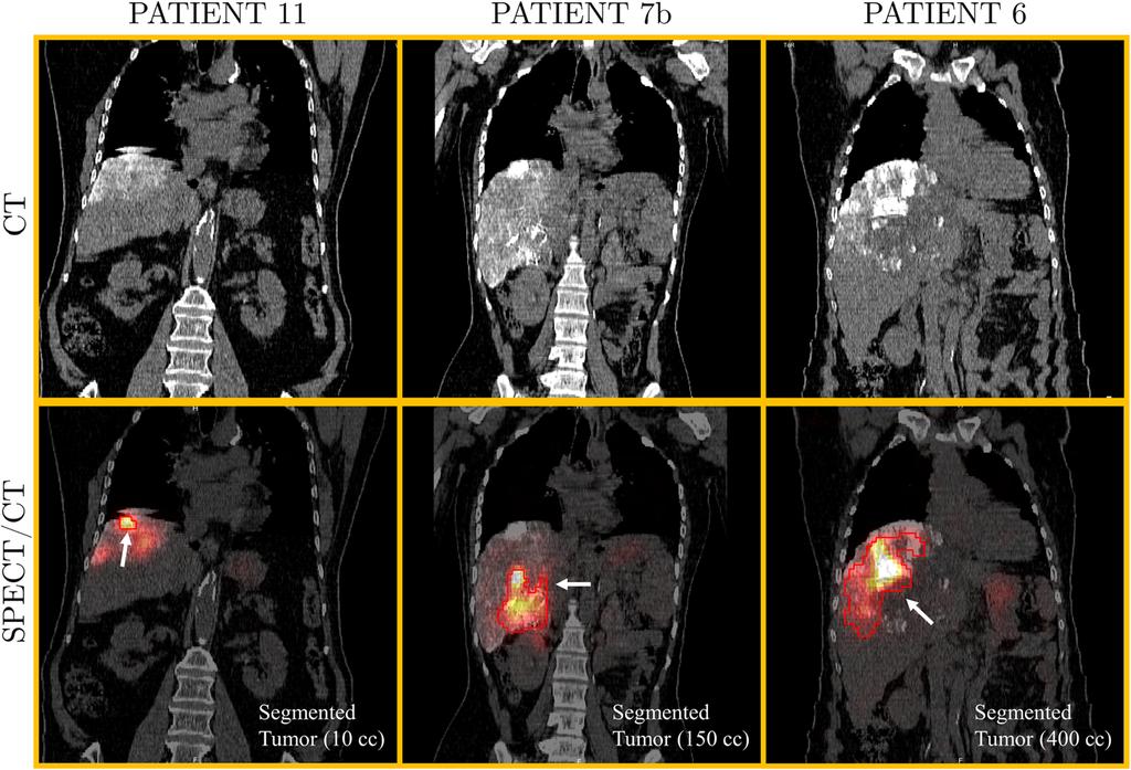 Esquinas et al. EJNMMI Physics (2018) 5:30 Fig. 2 CT and SPECT/CT coronal views of patient no.
