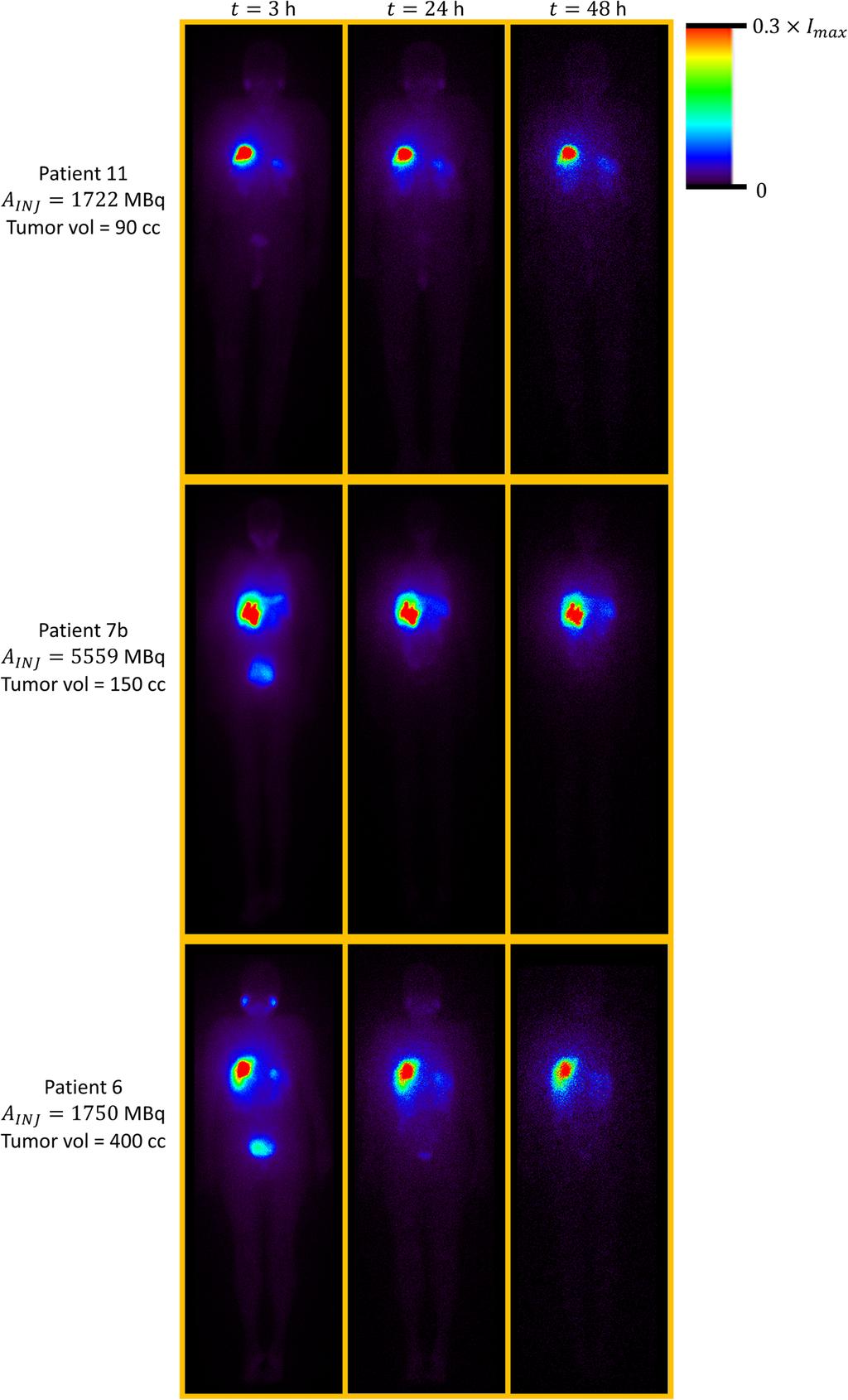Esquinas et al. EJNMMI Physics (2018) 5:30 Fig. 1 Whole-body planar images (anterior views) of three patients (no.