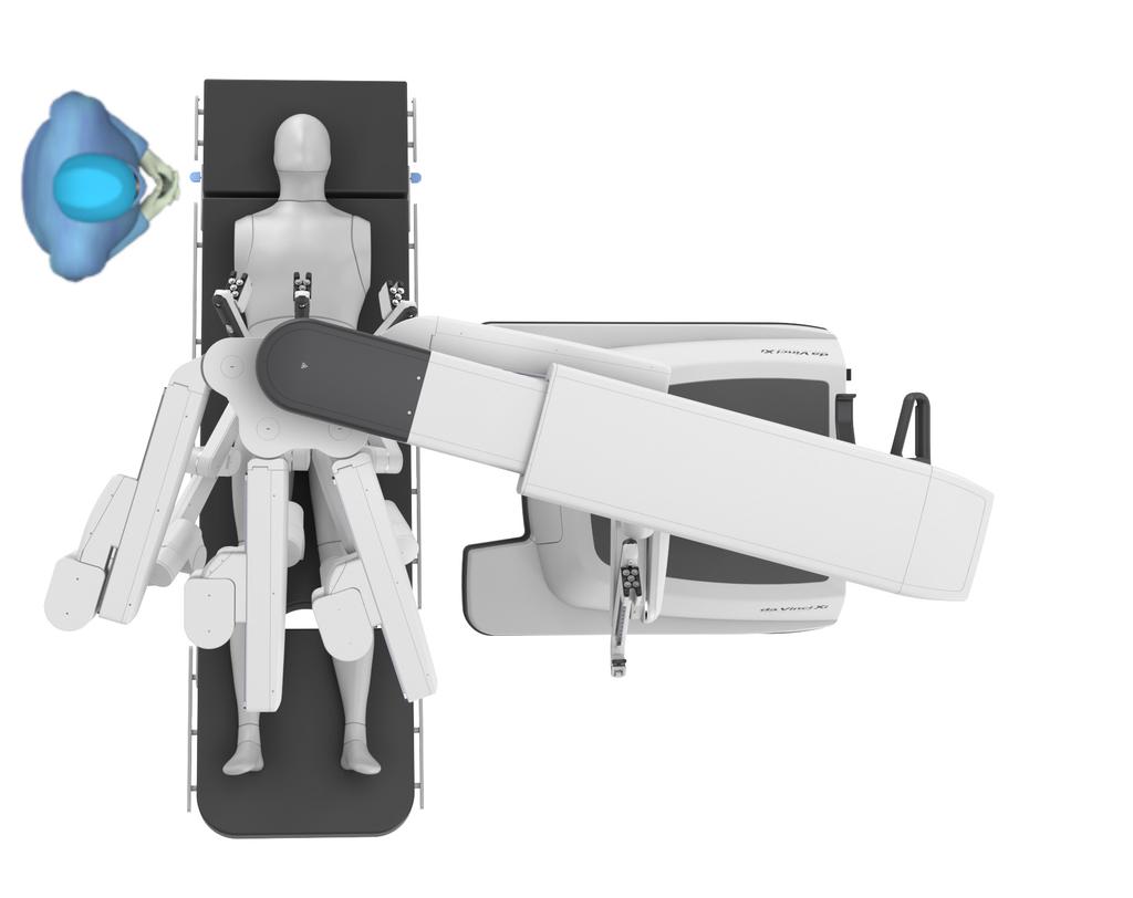 Select pelvic anatomy and Patient Cart location (approach from patient left shown in Figure 3). Deploy the da Vinci System for docking. Ensure the Patient Cart arms clear the patient.