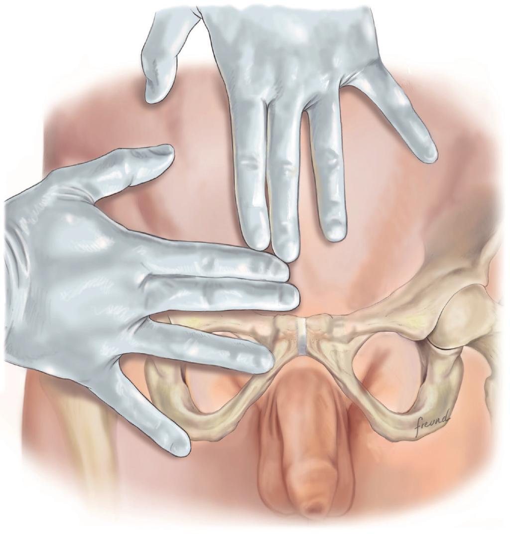 2 Surgery Research and Practice Aponeurosis of the internal oblique muscle 3-4 cm Aponeurosis of the external oblique muscle Figure 1: The incision is marked by the index and third fingers as shown.