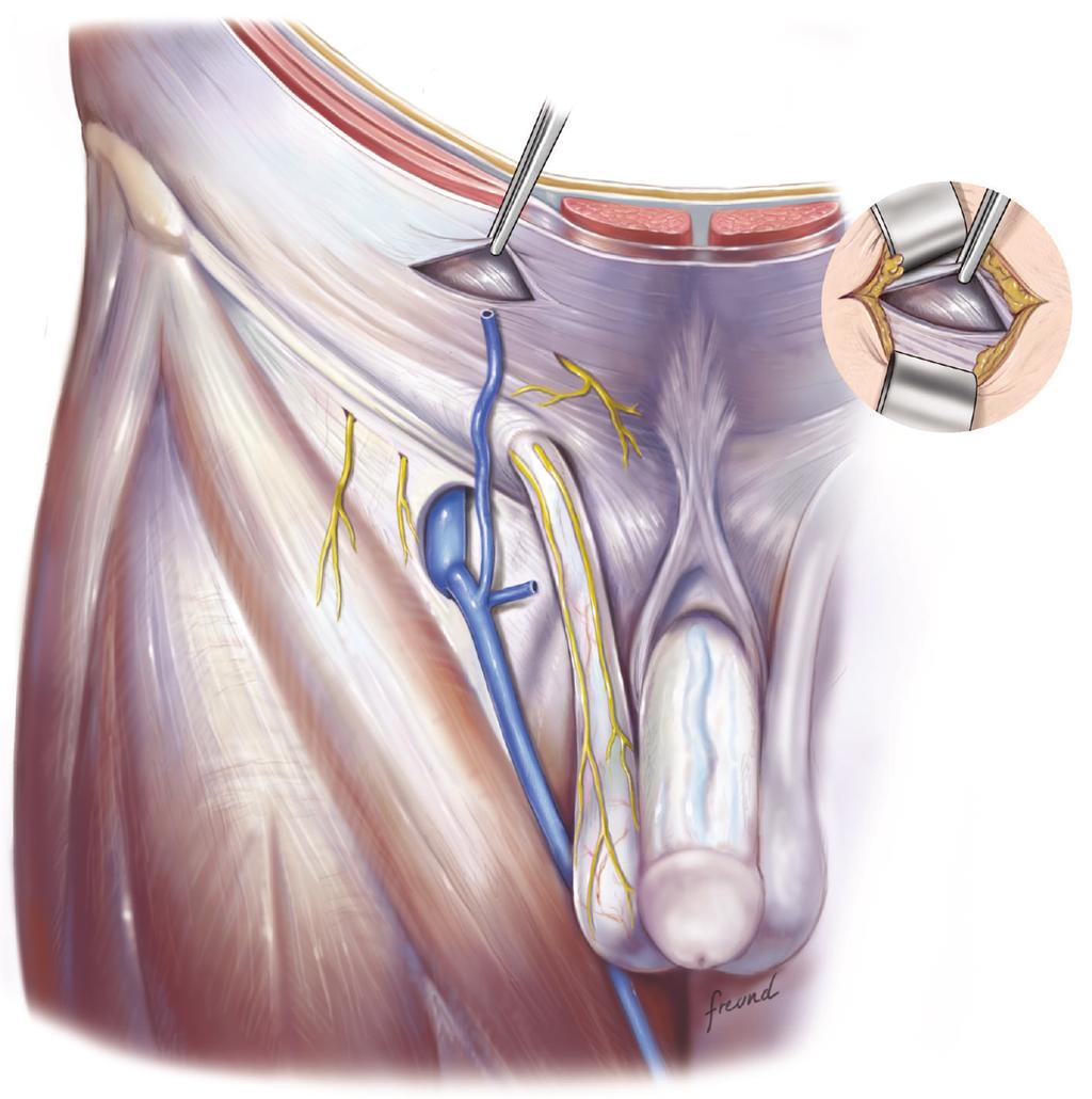 The procedure is conducted as follows: (i) Mark an incision line from the intersection of the index fingers placed superior and lateral to the midpoint of the pubic symphysis to a point 4 cm