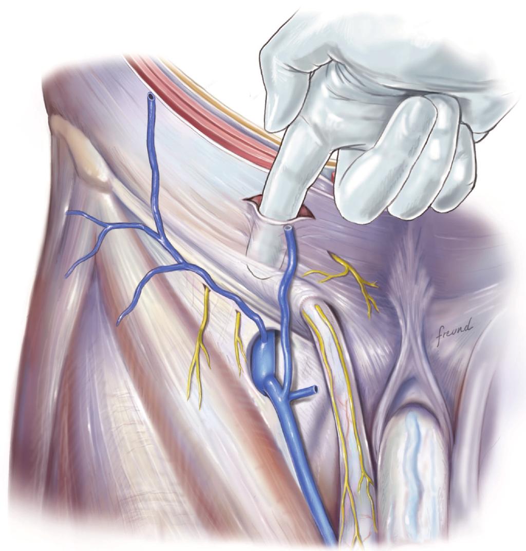 Surgery Research and Practice 3 Internal oblique muscle Figure 6: The index finger is used to plunge through the transversalis fascia into the preperitoneal space.