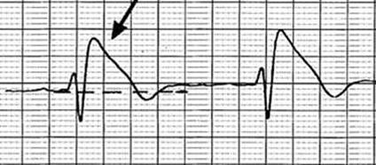 Brugada pattern Normal ECG of BrS may include dizziness, fainting, sudden death, or no symptoms at all.
