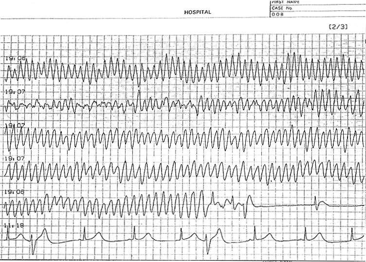 Holter ECG Recording in LQTS Patient with Syncope