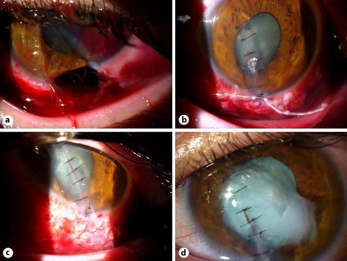 207 3 Agrawal R, Shah M, Mireskandari K, Yong GK: Controversies in ocular trauma classification and management: review. Int Ophthalmol 2013;33:435 445.