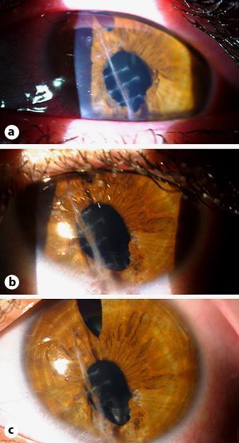 208 Fig. 2. a Day 1 after cataract extraction, anterior vitrectomy and peripheral iridectomy.