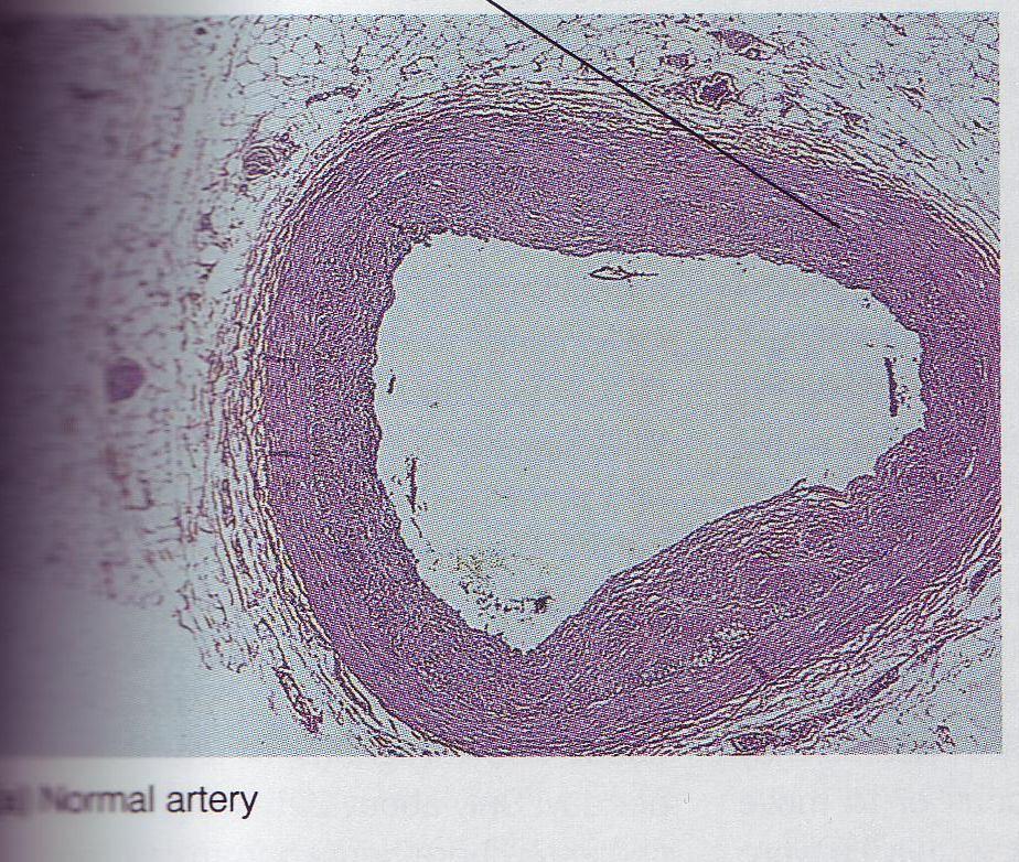 Normalna arterija Aterosklerotična arterija stena arterije stena arterije plak LDL in VLDL sta prinašalca holesterola na mesto mikro poškodb notranje površine žil (potreben je za