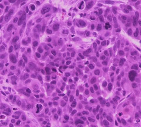 hepatocytes, accompanied by fibrosis