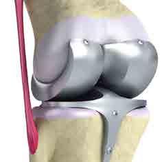OVERVIEW OF TOTAL KNEE REPLACEMENT The knee joint is the largest joint in the body. It is the hinge of the leg allowing the leg to bend and straighten.