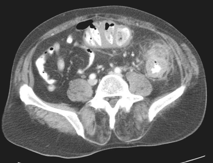 Investigated MDCT of Diverticulitis Frequency of findings of diverticulitis* Paracolonic fat stranding 100%