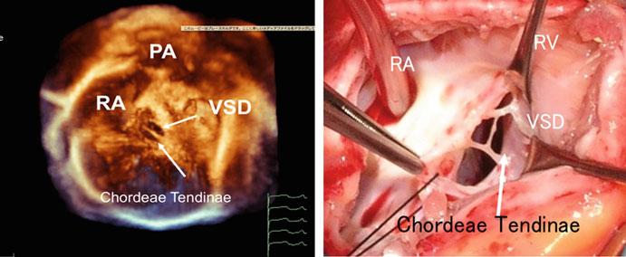 RA right atrium, PA pulmonary artery, RV right ventricle, VSD ventricular septal defect defect exists.