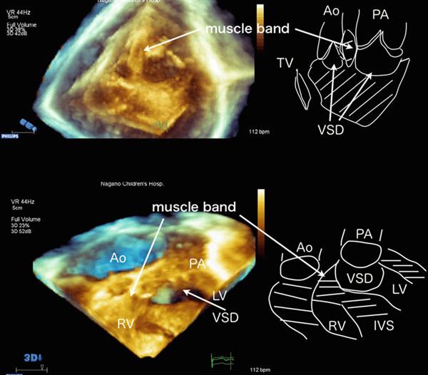 10 K. Takigiku Fig. 1.6 3D transpericardial echocardiography in a case with double-outlet right ventricle.