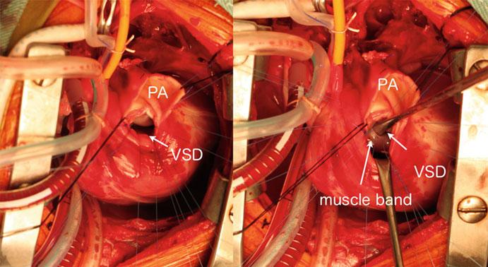 Ao aorta, PA pulmonary artery, TV tricuspid valve, LV left ventricle, VSD ventricular septal defect, IVS interventricular septum Fig. 1.