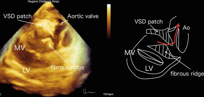 1 Real-Time Three-Dimensional (3D) Echocardiography for Diagnosis... 11 the muscle bundle as expected.