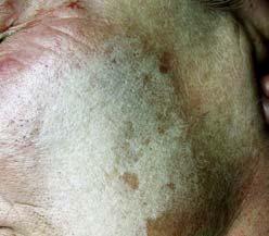 phenol penetrates slowly trough keratoses as you can see it on the