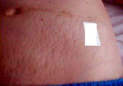 ) Atrophic or White stretch marks Actilift(DMAE) or