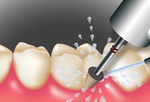 dentine-enamel bond (Futurabond U) for the dental
