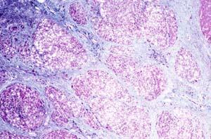 Fibrosis Can Occur in Any Organ and Can Lead to Irreversible Organ Damage Various theories have been proposed for the pathogenesis of
