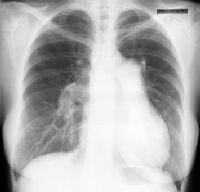 Pulmonary Manifestations of Scleroderma Normal Pulmonary Pulmonary Hypertension