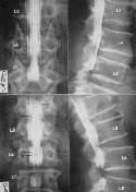 Lumbar spine examined by Myelogram Flexion exam (top 2) Extension exam (bottom 2) L5 radiculopathy secondary to stenosis MRI most sensitive
