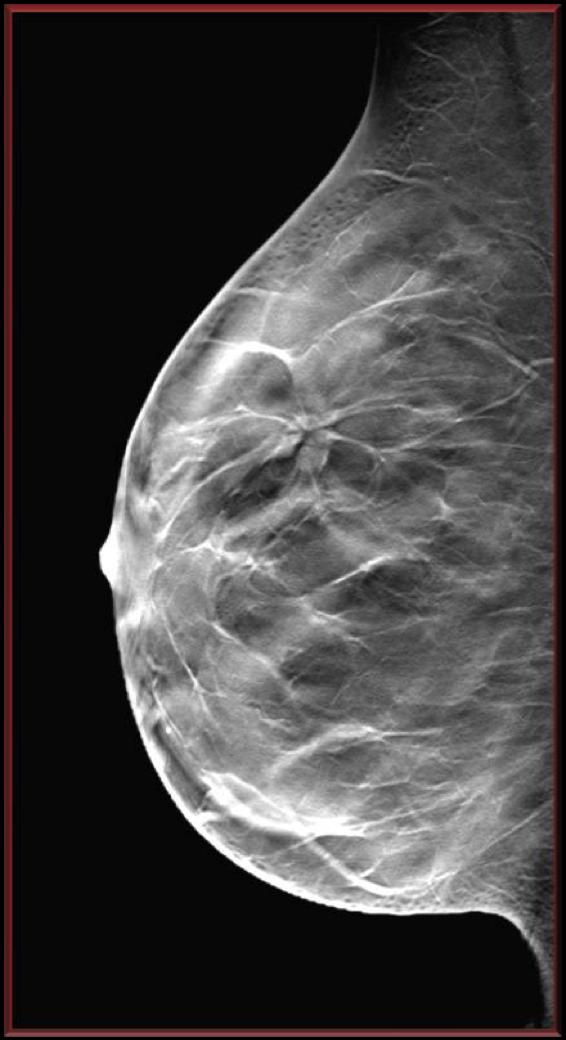 Mean Glandular Dose (MGD): average dose absorbed during image acquisi/on in the breast glandular
