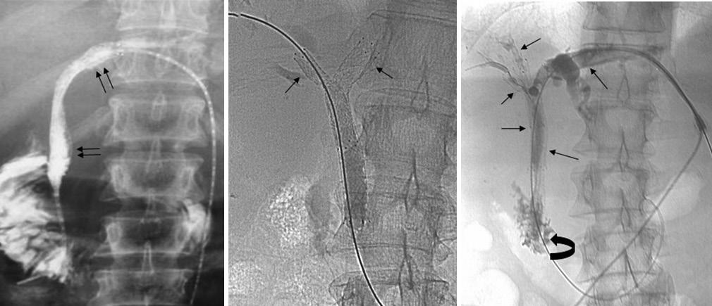 in the first ttempt nd incresed risk of ctheter dislodgement. [1] BILIARY STENTING Biliry stenting cn e performed endoscopiclly, percutneously, or y the comined mens.