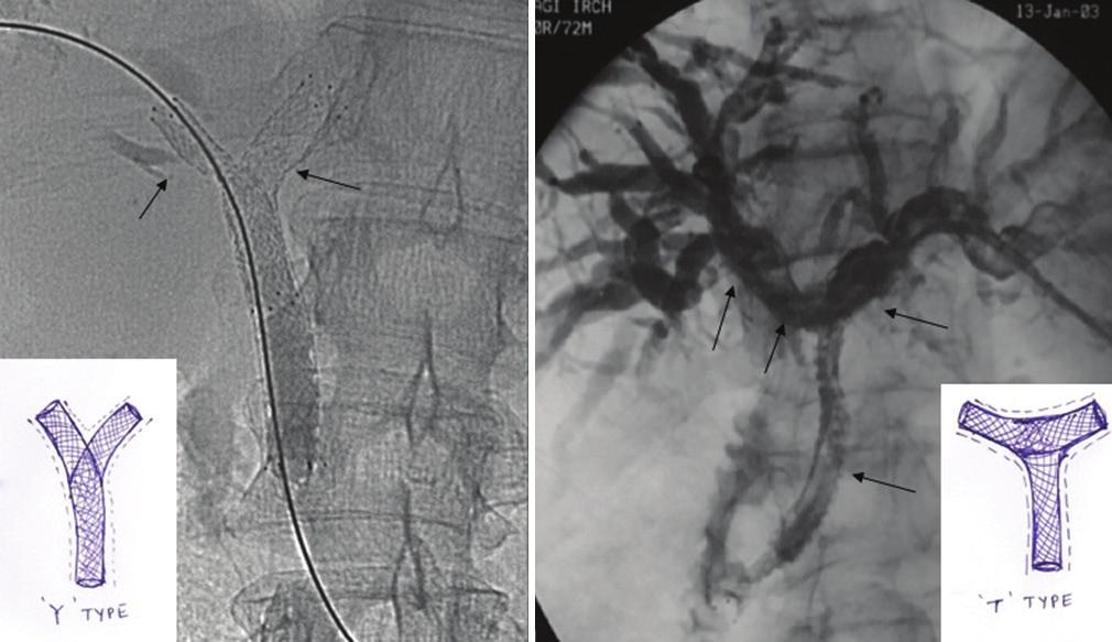 Tle 4: Selection of percutneous iliry ccess for stent deployment on the sis of type of lock Type of hilr lock (Bismuth- Corlette clssifiction) I, II Left III, III IV CBD: Common ile duct ccess is