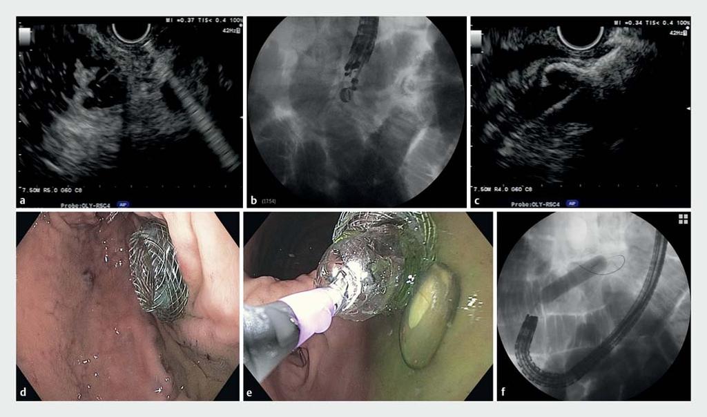 Fig.1 EUS-GJ using the direct technique in a 70-year-old patient with malignant GOO and biliary obstruction secondary to pancreatic head adenocarcinoma.