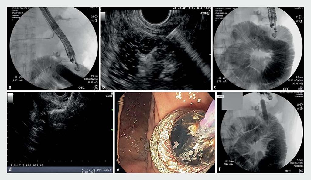 Fig.2 EUS-GJ using the balloon-assisted technique in a 74-year-old patient with malignant GOO and biliary obstruction secondary to pancreatic head adenocarcinoma causing duodenal obstruction.
