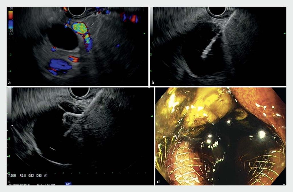 Fig.3 EUS-GBD in a 70-year-old patient with malignant GOO and biliary obstruction secondary to pancreatic head adenocarcinoma. The linear echoendoscope is advanced into proximal duodenum.