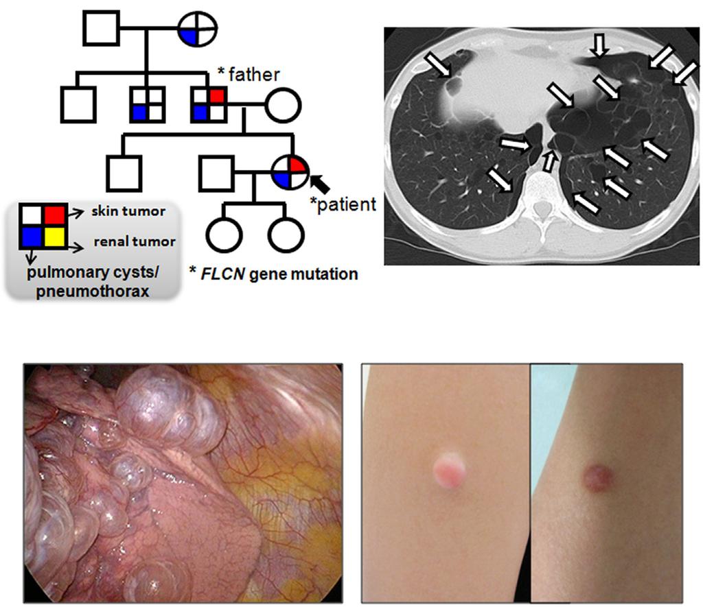 48 T. Nishii et al. (a) b c d e Figure 1 Inheritance of phenotypes, and radiologic and macroscopic findings. (a) Pneumothorax is the main manifestation of this family.