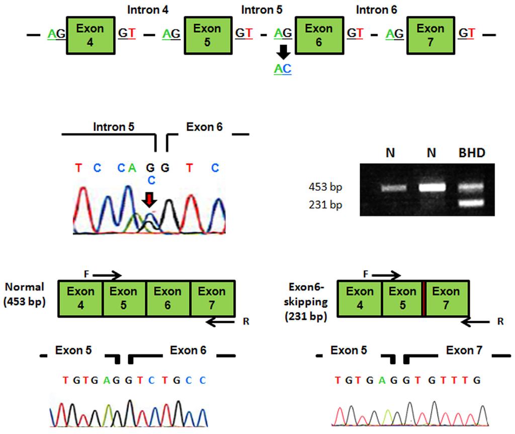 50 T. Nishii et al. (a) (b) (c) (d) (e) Figure 3 Analysis of folliculin gene mutation and folliculin mrna. (a) A schema of folliculin (FLCN) gene. The 3 end of intron 5 is mutated in this case.