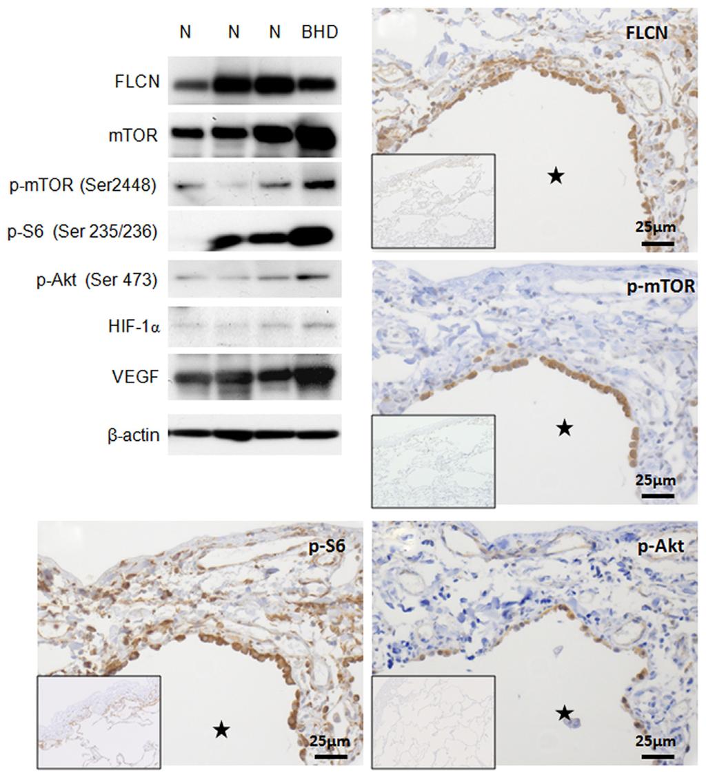 Accelerated mtor signaling in BHD lung 51 (a) b c d e Figure 4 Expression of folliculin and mtor signaling molecules in Birt-Hogg-Dubé lung.