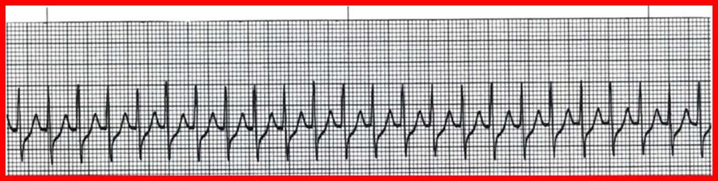 NWC EMSS CE Credit Questions Page 5 22. Identify the steps required when initiating pacing a patient using your current monitor. 23.